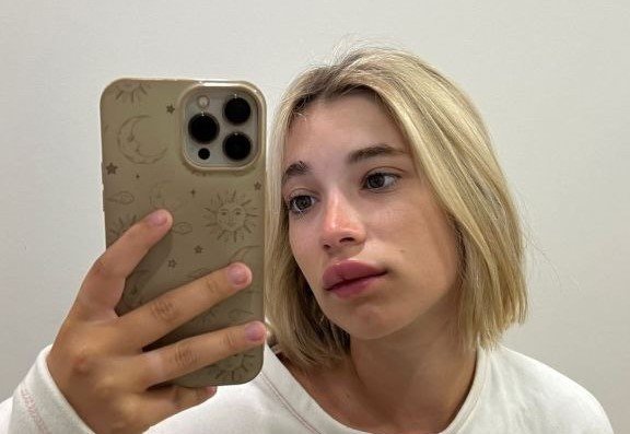Rebeca Stones comparte una fotografía con los labios hinchados. // Instagram